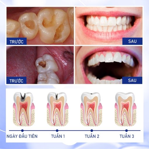 【BÁN CHẠY】Kem đánh răng phục hồi sâu răng Loại bỏ sâu răng, giảm đau và phục hồi răng bình thường - Ảnh 4