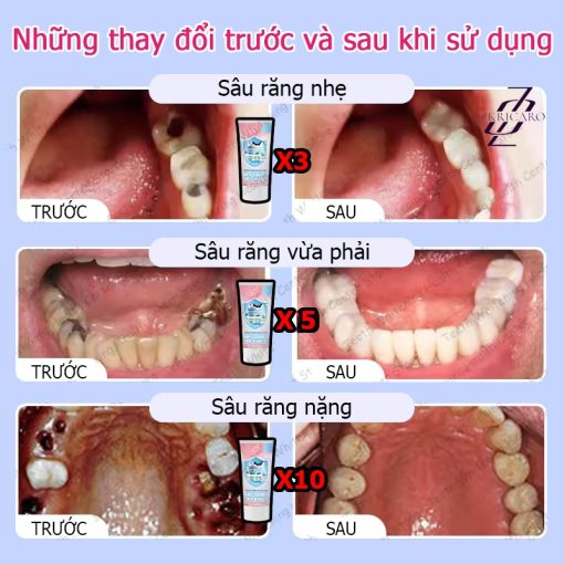 【BÁN CHẠY】Kem đánh răng phục hồi sâu răng Loại bỏ sâu răng, giảm đau và phục hồi răng bình thường - Ảnh 5