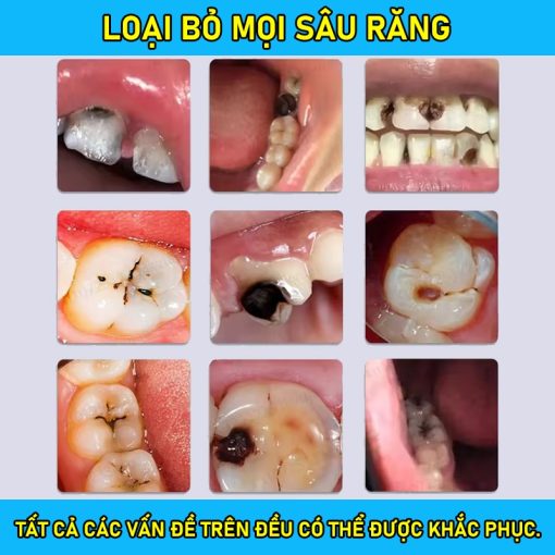 【BÁN CHẠY】Kem đánh răng phục hồi sâu răng Loại bỏ sâu răng, giảm đau và phục hồi răng bình thường - Ảnh 3